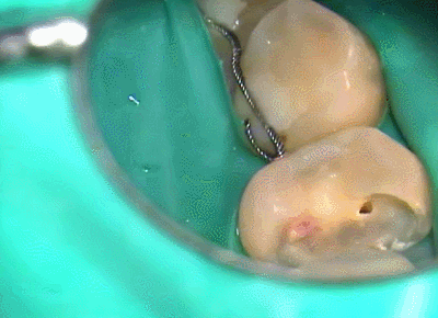 2014.09.13 髄腔の状態.gif